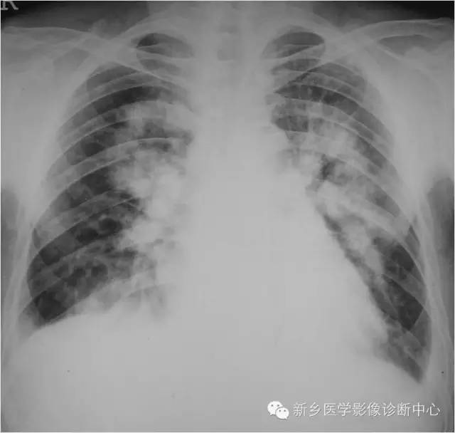 【病例】肺水肿1例影像表现与鉴别