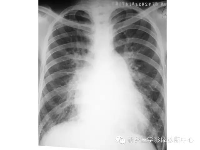 【病例】肺水肿1例影像表现与鉴别