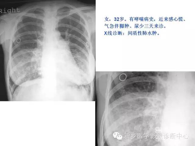 【病例】肺水肿1例影像表现与鉴别