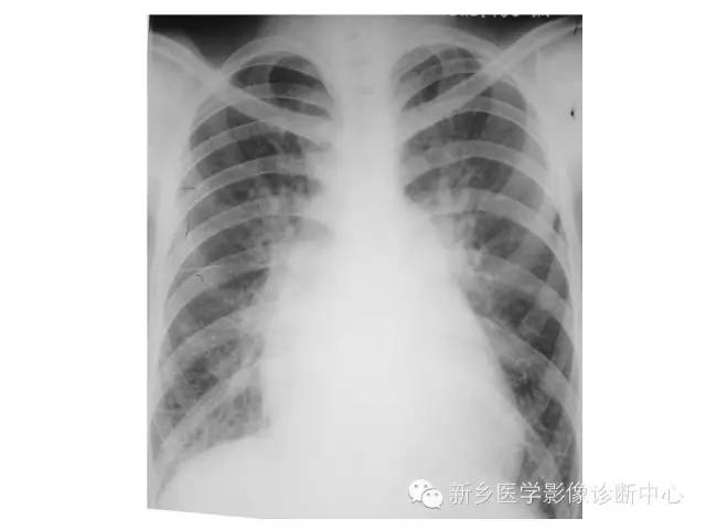 【病例】肺水肿1例影像表现与鉴别