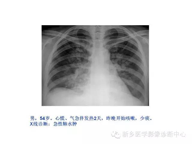 【病例】肺水肿1例影像表现与鉴别