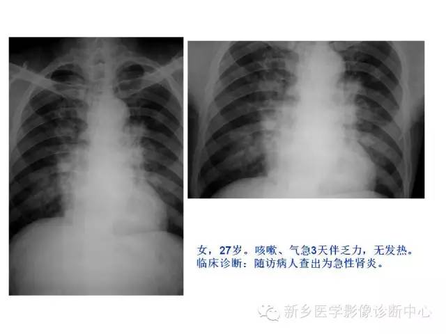 【病例】肺水肿1例影像表现与鉴别