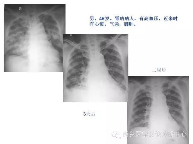 【病例】肺水肿1例影像表现与鉴别
