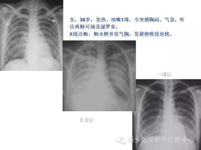【病例】肺水肿1例影像表现与鉴别