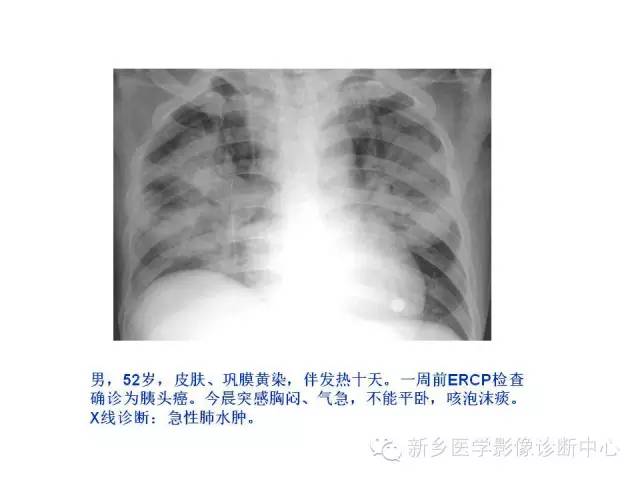 【病例】肺水肿1例影像表现与鉴别