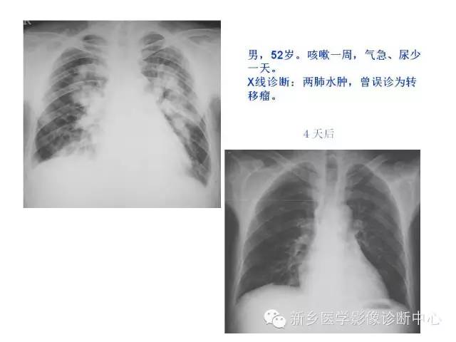 【病例】肺水肿1例影像表现与鉴别