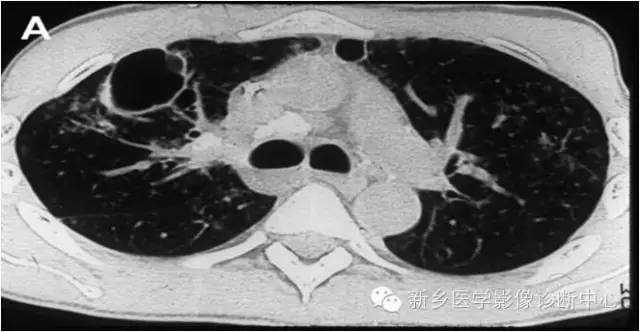 脾脏钙化的影像表现 脾脏钙化的影像表现