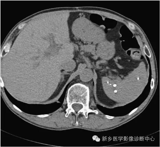 脾脏钙化的影像表现