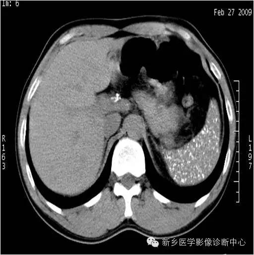 脾脏钙化的影像表现 脾脏钙化的影像表现