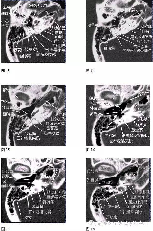 颞部横断位、冠状位解剖+详细标注