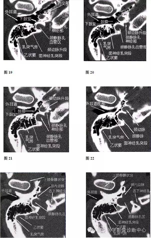 颞部横断位、冠状位解剖+详细标注
