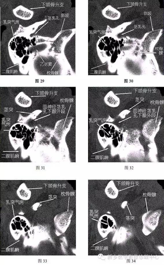 颞部横断位、冠状位解剖+详细标注