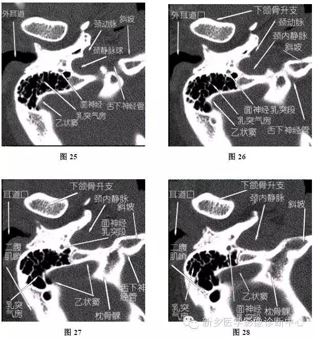 颞部横断位、冠状位解剖+详细标注