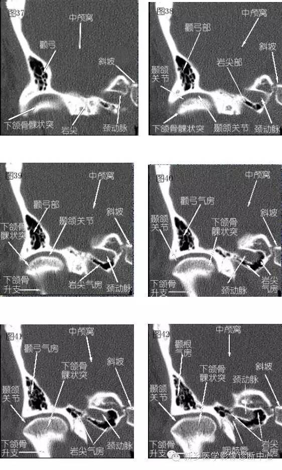 颞部横断位、冠状位解剖+详细标注