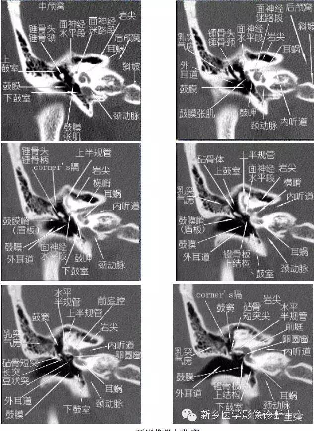 颞部横断位、冠状位解剖+详细标注