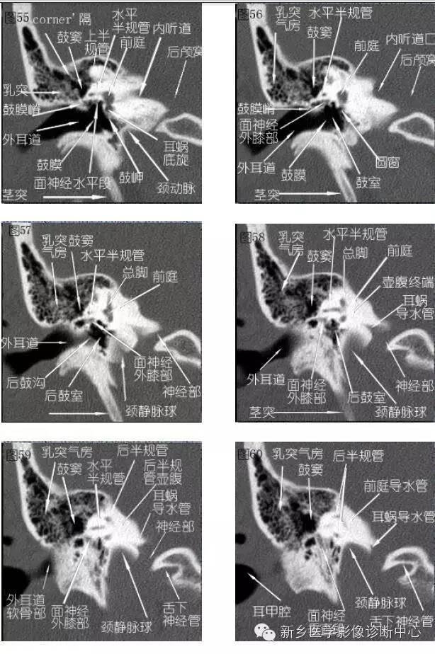 颞部横断位、冠状位解剖+详细标注