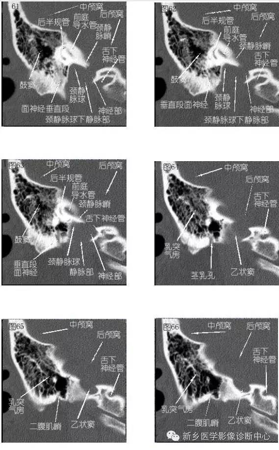 颞部横断位、冠状位解剖+详细标注