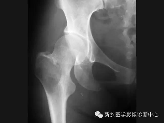 【病例】股骨骨巨细胞瘤1例影像表现