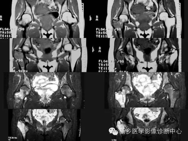 【病例】股骨骨巨细胞瘤1例影像表现