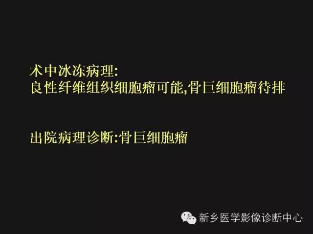 【病例】股骨骨巨细胞瘤1例影像表现