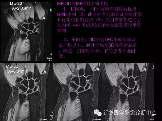 【PPT】三角纤维软骨复合体损伤的MRI诊断