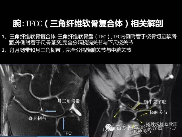【PPT】三角纤维软骨复合体损伤的MRI诊断