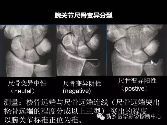 【PPT】三角纤维软骨复合体损伤的MRI诊断
