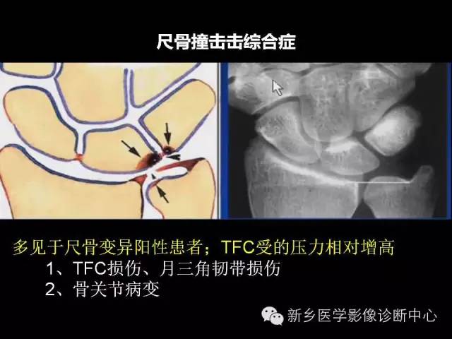 【PPT】三角纤维软骨复合体损伤的MRI诊断