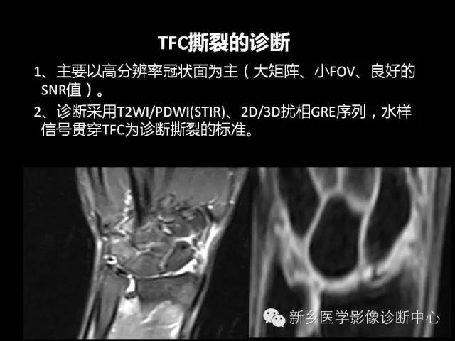 【PPT】三角纤维软骨复合体损伤的MRI诊断