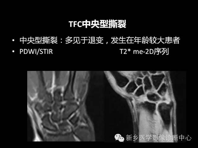 【PPT】三角纤维软骨复合体损伤的MRI诊断