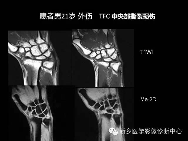 【PPT】三角纤维软骨复合体损伤的MRI诊断