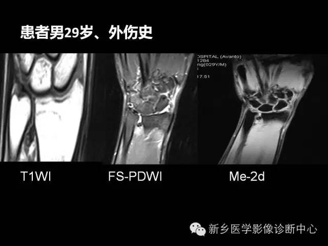 【PPT】三角纤维软骨复合体损伤的MRI诊断