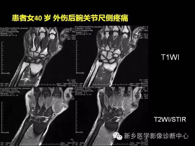【PPT】三角纤维软骨复合体损伤的MRI诊断