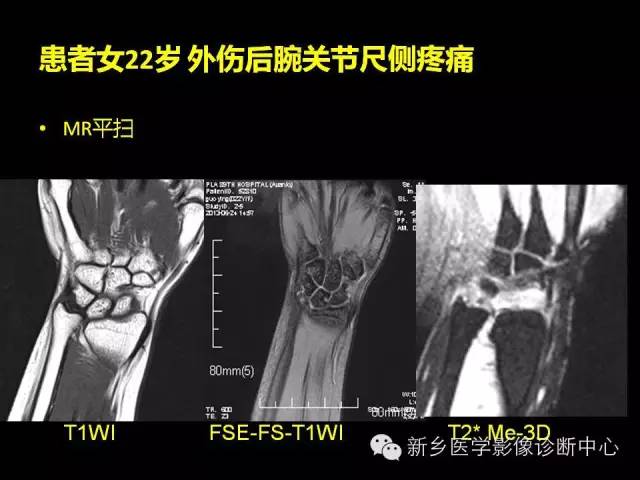 【PPT】三角纤维软骨复合体损伤的MRI诊断