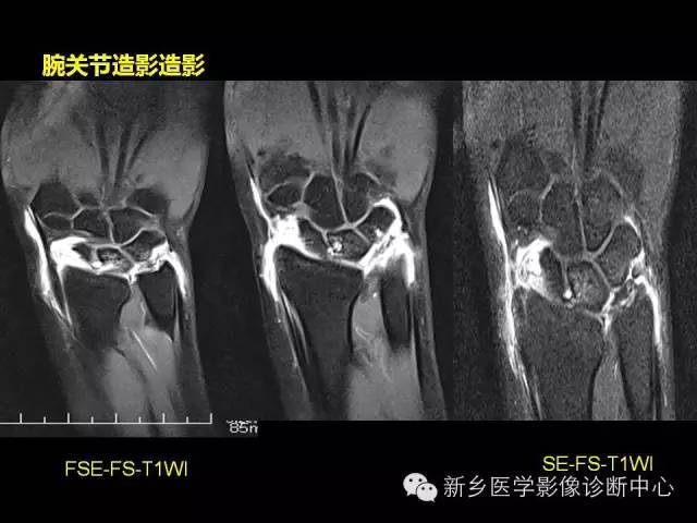 【PPT】三角纤维软骨复合体损伤的MRI诊断