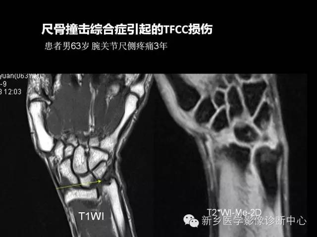 【PPT】三角纤维软骨复合体损伤的MRI诊断