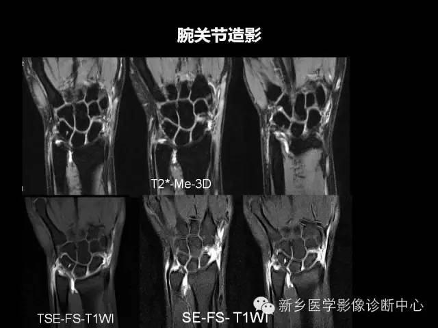 【PPT】三角纤维软骨复合体损伤的MRI诊断