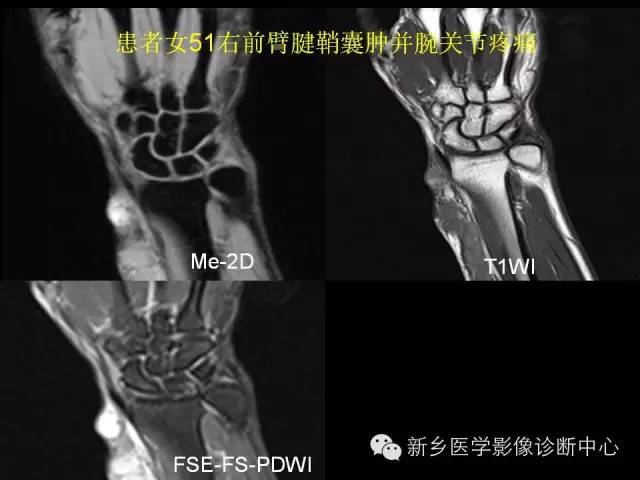 【PPT】三角纤维软骨复合体损伤的MRI诊断