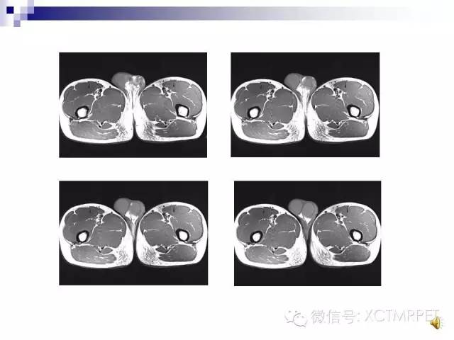 【PPT】睾丸生殖细胞肿瘤的磁共振诊断