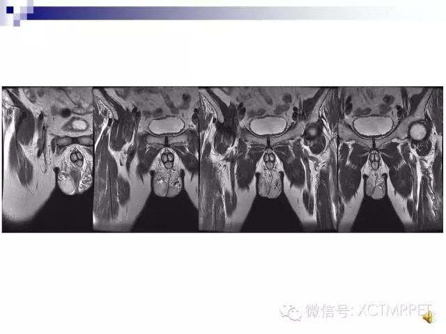 【PPT】睾丸生殖细胞肿瘤的磁共振诊断