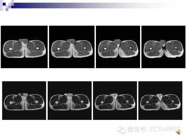 【PPT】睾丸生殖细胞肿瘤的磁共振诊断