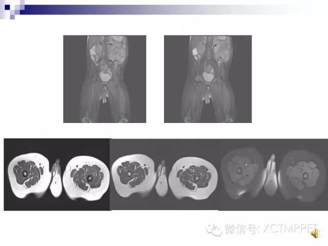【PPT】睾丸生殖细胞肿瘤的磁共振诊断