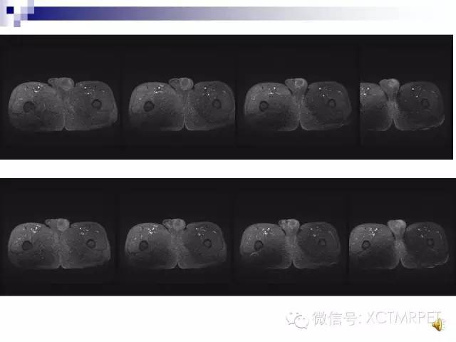 【PPT】睾丸生殖细胞肿瘤的磁共振诊断