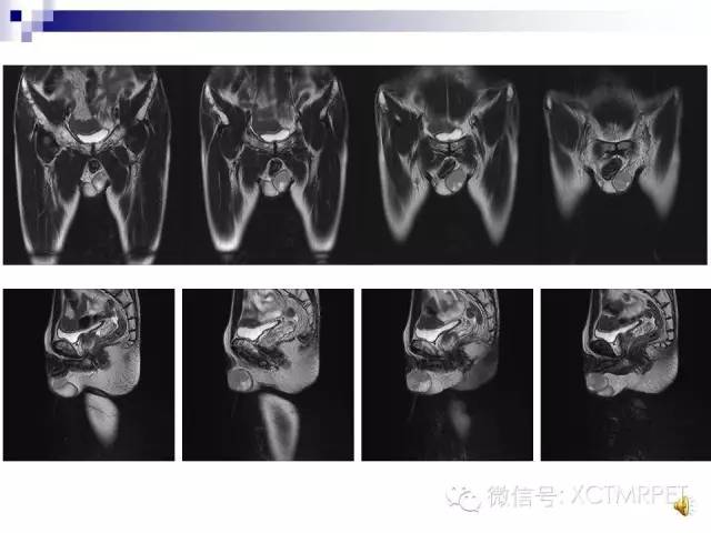 【PPT】睾丸生殖细胞肿瘤的磁共振诊断