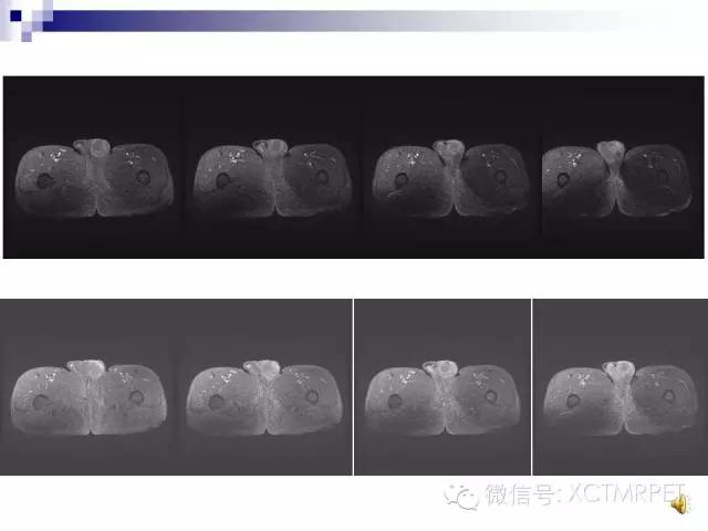【PPT】睾丸生殖细胞肿瘤的磁共振诊断