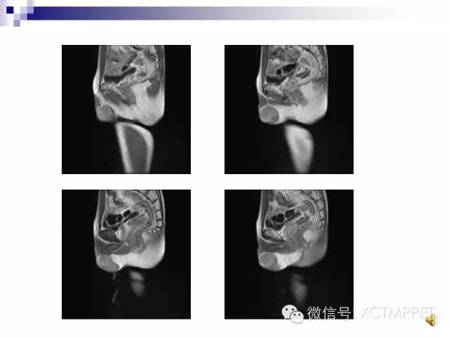 【PPT】睾丸生殖细胞肿瘤的磁共振诊断