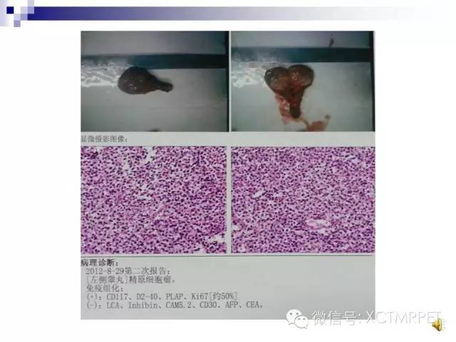 【PPT】睾丸生殖细胞肿瘤的磁共振诊断