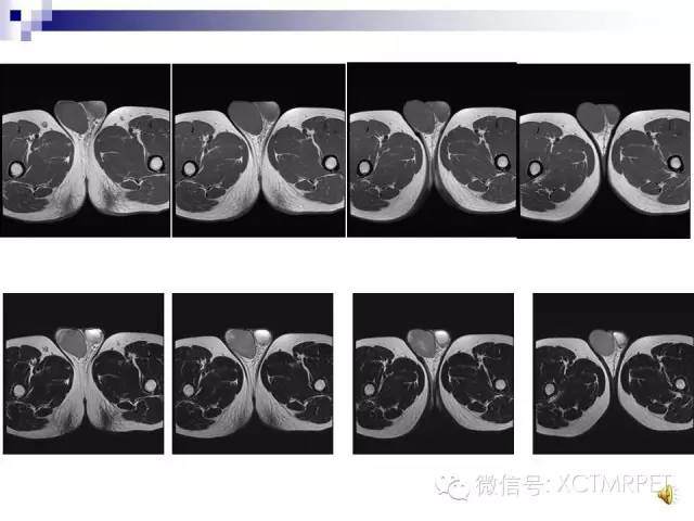【PPT】睾丸生殖细胞肿瘤的磁共振诊断