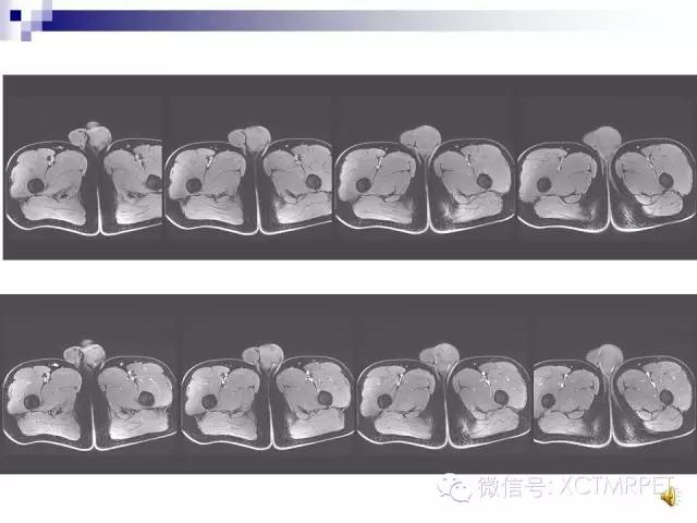 【PPT】睾丸生殖细胞肿瘤的磁共振诊断