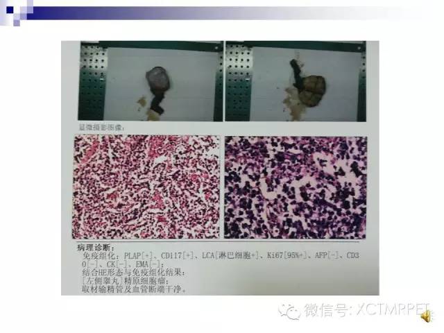 【PPT】睾丸生殖细胞肿瘤的磁共振诊断